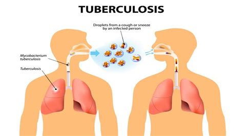 Other symptoms that sometimes occur include back, flank, and suprapubic pain; Early Warning Signs And Symptoms Of Tuberculosis - YouTube