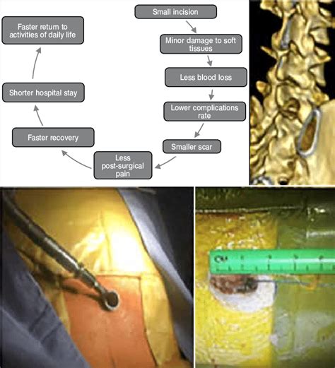 Advantages Of Minimally Invasive Spine Surgery Download Scientific