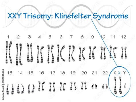 Klinefelter Syndrome Karyotype Stock Vector Adobe Stock