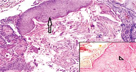 Squamous Cell Carcinoma Arising In An Epidermal Cyst Indian Journal
