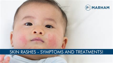 Common Rashes In Kids What To Do Vlrengbr