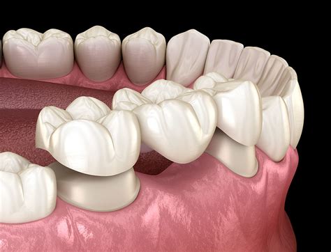 What Are Dental Bridges Willows Dentistry