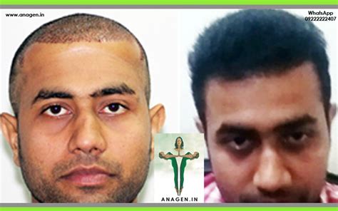 Effluviums characteristically affect different phases of the hair growth cycle. Anagen Hair Transplant Clinic- Mumbai in Mumbai, India ...