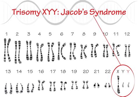 Trisomy Xyy Jacobs Syndrome 7818648 Vector Art At Vecteezy