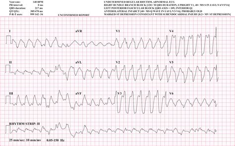 Ventricular Tachycardia Vt Types And Ecg Online Medical Library Hot