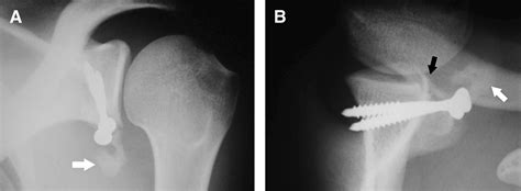 Recurrent Anterior Dislocation After The Latarjet Procedure Outcome