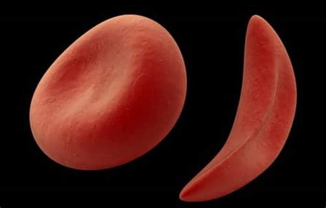Oxbryta Approved By Fda For Sickle Cell Disease Rt