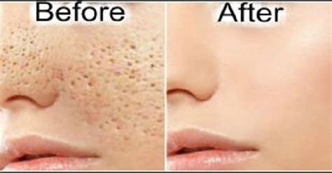 How To Reduce Pore Size Top 5 Diy