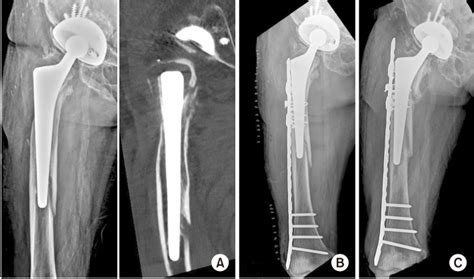 Treatment Of Periprosthetic Femoral Fractures After Hip Arthroplasty
