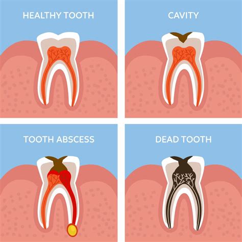 What does sensitivity after a filling feel like? I Think I Have a Dead Tooth — What Do I Do?