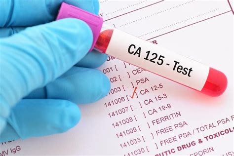 Cancer antigen 125 (ca125) is a protein found on most ovarian cancer cells that is secreted into the blood stream and can be measured. CA125 Test - What It Is and Why I Need to Undergo ...