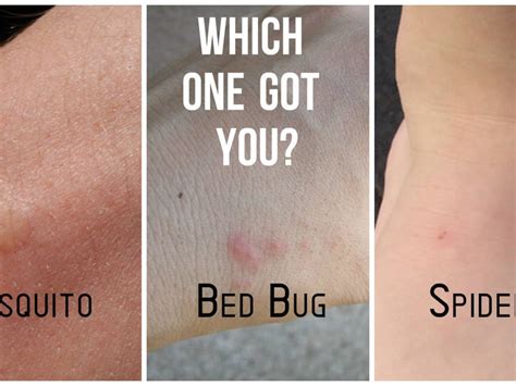 Can Bed Bug Bites Look Like Ringworm Pest Phobia
