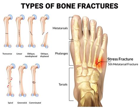Stress Fracture In Ankle Hot Sex Picture