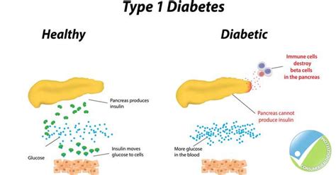 Type 1 Diabetes - UAI Research