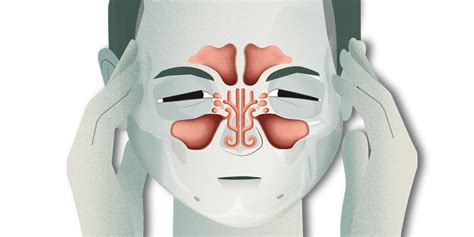 Sinusitis Causas Síntomas Tratamiento PortalclÍnic