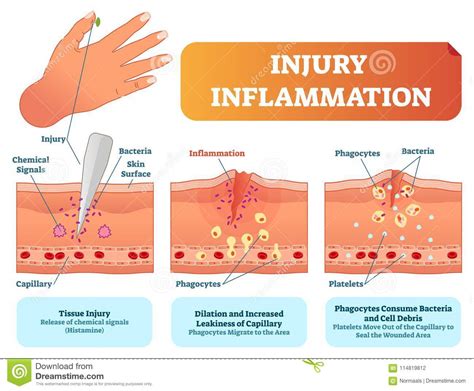 Inflammation Cartoons Illustrations And Vector Stock Images 37361