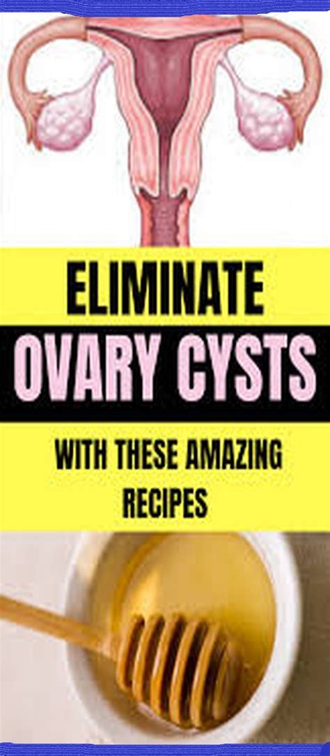 Wellness In 2020 Cyst On Ovary Ovaries Cysts