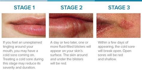 People can develop a cold sore on their lips or in their mouth. Cold Sore Stages: Identification and Treatment