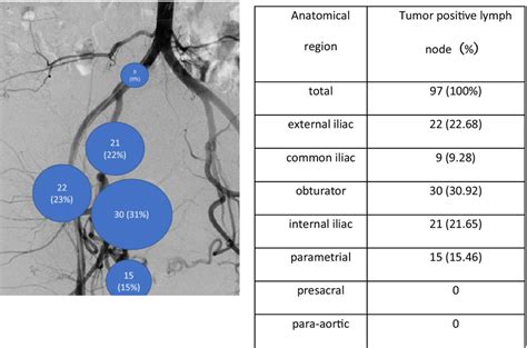 The Distribution Of Lymph Node Metastasis In The Patients With Stage