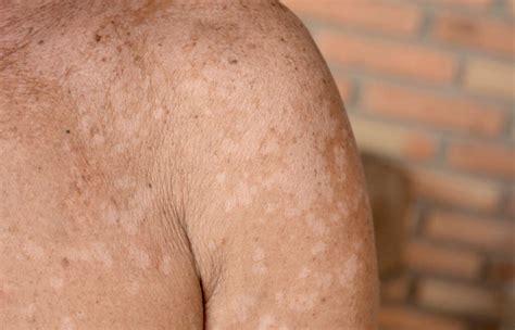 White Spots On Skin What Causes White Spots On Skin