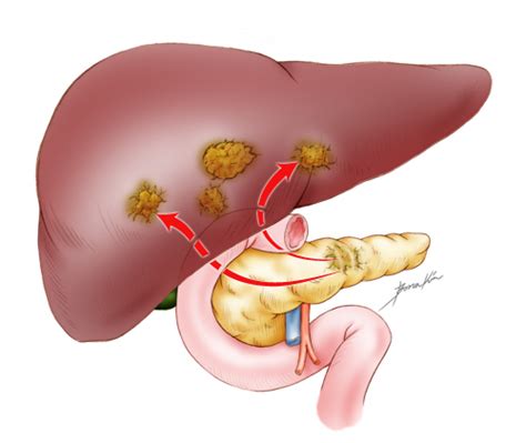 Since these tumors often block the bile duct, jaundice is another common sign. Diagnosis