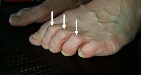 Clawed Toes And Hammer Toes Make The Toe Joints Sit Up Higher And Are