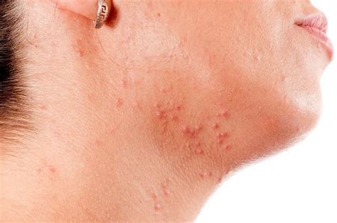 Frequently Asked Questions About Folliculitis
