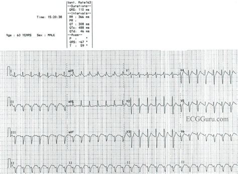 Paroxysmal supraventricular tachycardia (psvt) is a type of abnormal heart rhythm, or arrhythmia. Psvt Ecg - Supraventricular Tachycardia Svt Acls ...