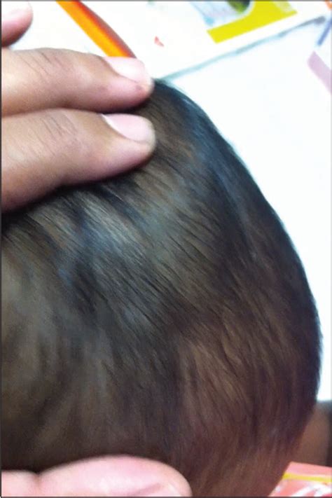 Subaponeurotic Fluid Collection An Unusual Cause Of Scalp Swelling In