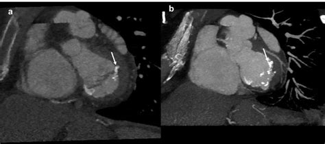 62 Yo Female With Caseous Calcification Of The Mitral Annulus
