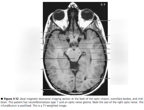 Axial Magnetic Resonance Imaging Section At The Level Of The Optic