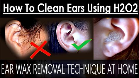Ear Wax Removal Technique At Home How To Clean Ears Using Hydrogen