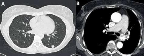 A Ct Chest Demonstrating A Peripheral Nodule On The Left Lower Lobe