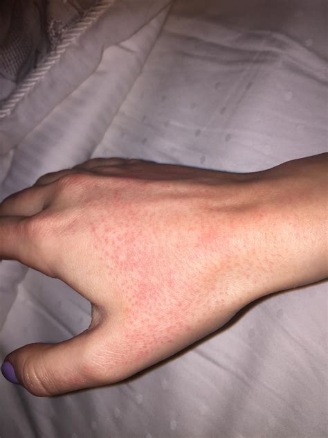 Help Rash On Hands From Accutane Prescription Acne Medications By