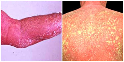 Eczema Complications Series Erythroderma Eczema Blues