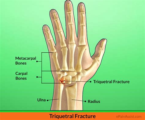 Triquetral Fracture Treatment Exercises Causes Symptoms Signs