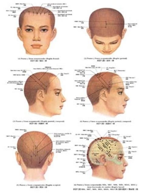 The purpose of this paper is to review the literature on the use of acupuncture to treat ms. MS Acupuncture Clinic INC. - Scalp Acupuncture