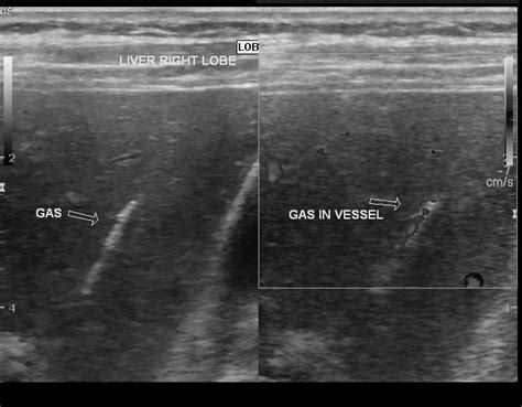 Small bowel obstruction (string of pearls sign) | Image | Radiopaedia.org