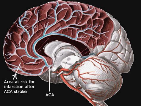 Figure Anterior Cerebral Artery Stroke Image Courtesy S Bhimji Md Statpearls Ncbi Bookshelf