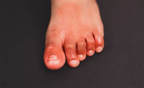Painful Red Inflammation On Toe Called Covid Toe Lesions Strange Sign