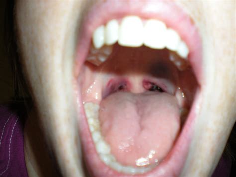 Swollen Uvula Symptoms