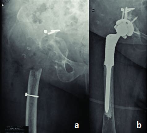 A Anteroposterior View Of Excision Arthroplasty With Massive Bone Loss