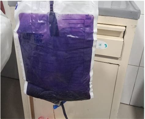 Purple Discoloration Of Urine For Interpretation Of The References To