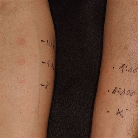 Amoxicillin Rash In A Patient With Infectious Mononucleosis Patient