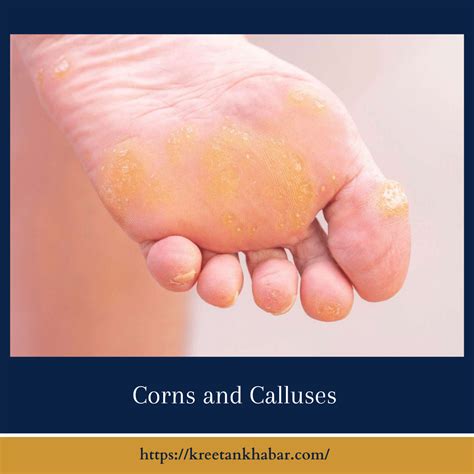 Corns and Calluses: Causes, Treatment, and Prevention - Kreetan Khabar