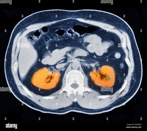 Ct Scan Of The Abdomen Showing A Small Kidney Stone Stock Photo Alamy