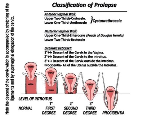 degrees of uterine prolapse medizzy