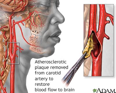 Blocked arteries in neck, produce symptoms only when the blockage is severe. Neurology Center - Penn State Hershey Medical Center - Carotid artery surgery - Penn State ...
