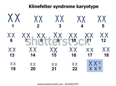 Klinefelter Syndrome Karyotype Lagerillustration 263682395