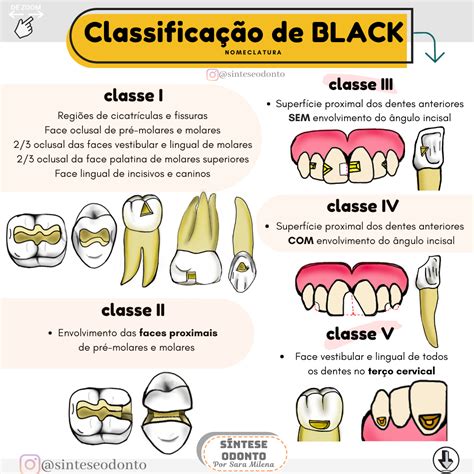 Classificação De Black Odontologia Tudo Sobre Odontologia Medicina Dentária